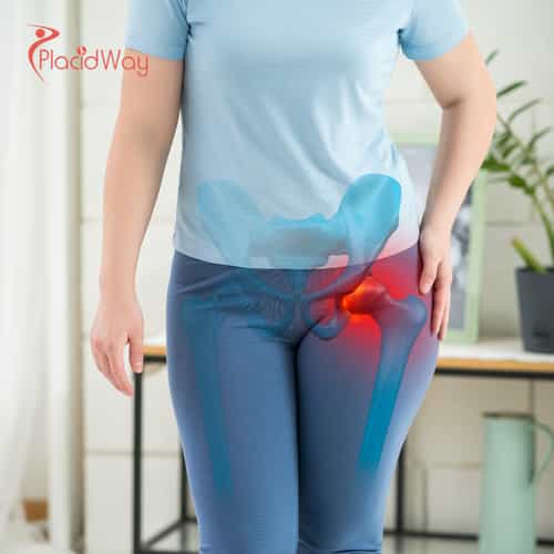 Hip Replacement Surgery in Turkey: Cost-Effective Orthopedic Care for Australian Tourists